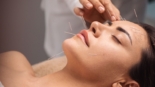 acupuncture